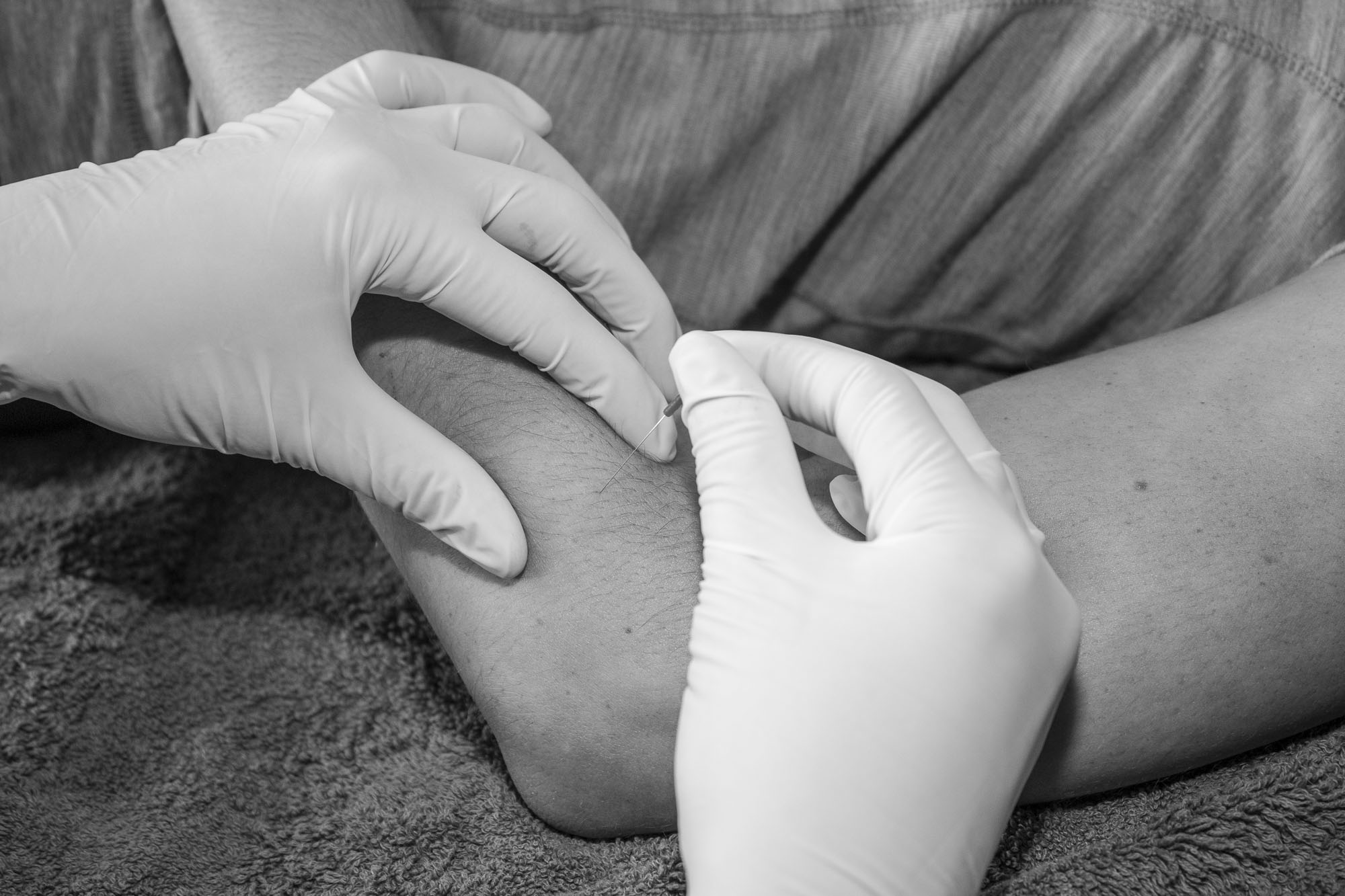 Triggerpunkttherapie DryNeedling